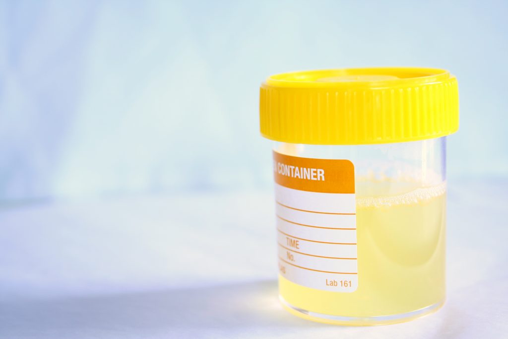 A lab sample container filled with urine.