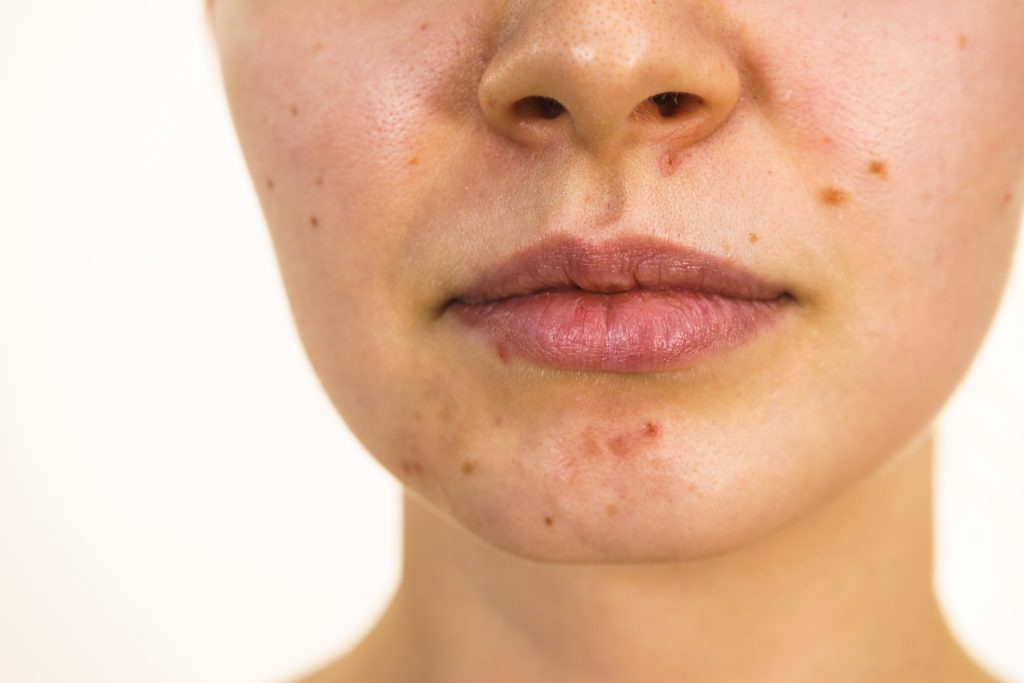 Female face with acne skin problem
